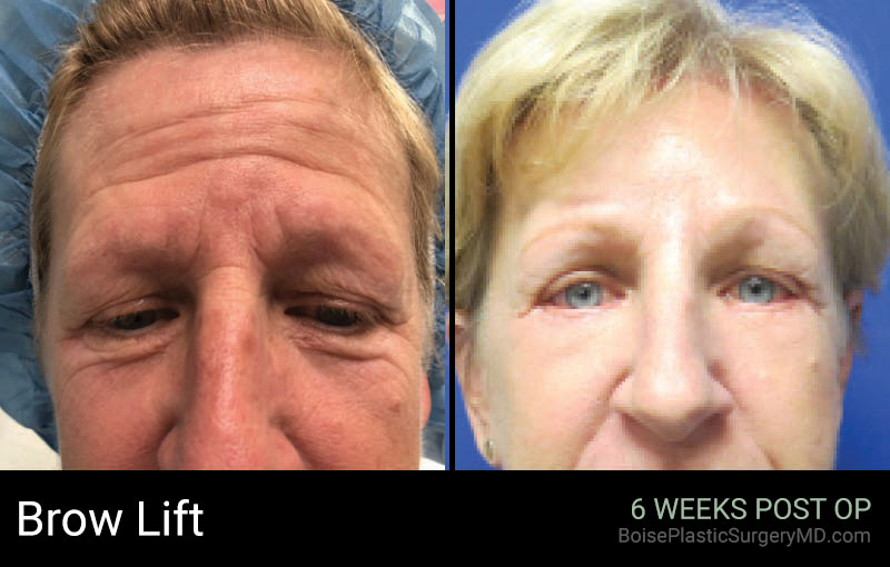 Brow Lift – Patient A