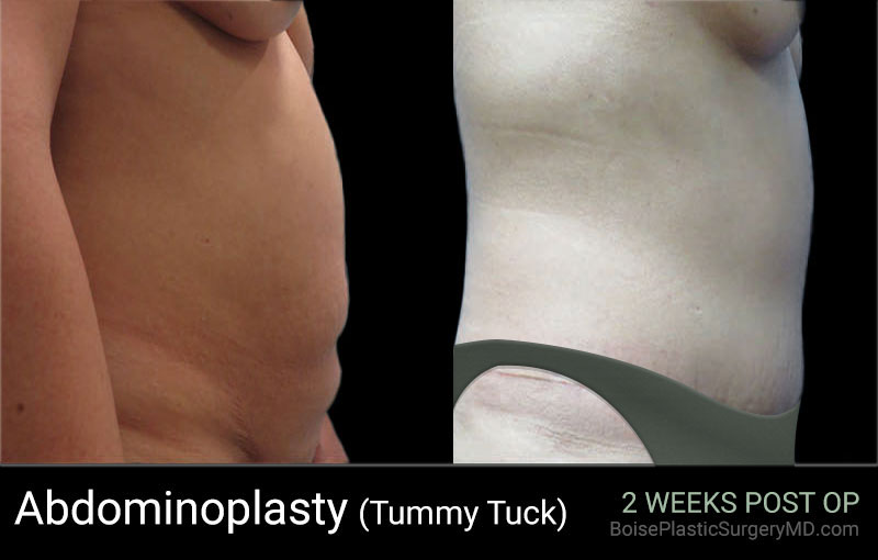 Abdominoplasty - Patient A Side View - Boise Plastic Surgery