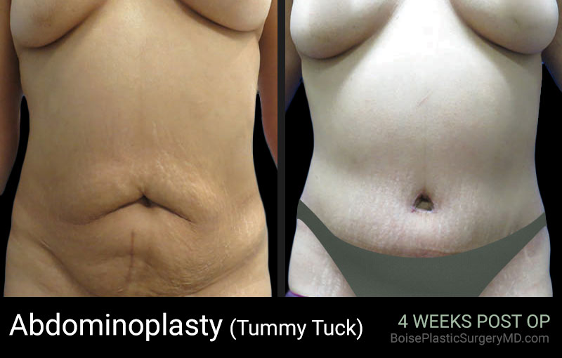 Abdominoplasty - Boise Plastic Surgery
