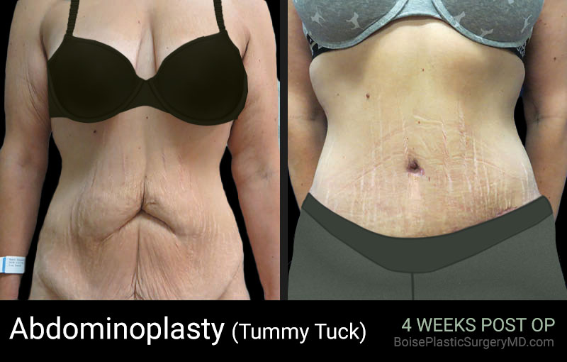 Abdominoplasty (Patient B Front) - Boise Plastic Surgery