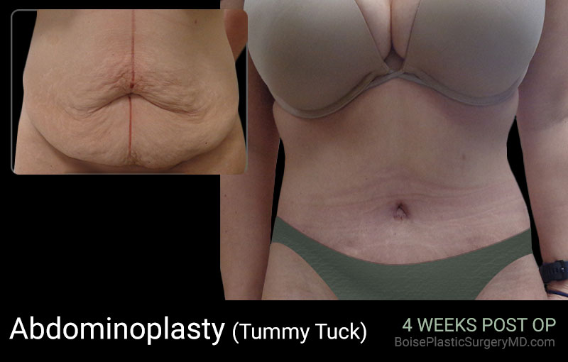 Abdominoplasty (Patient B Front) - Boise Plastic Surgery