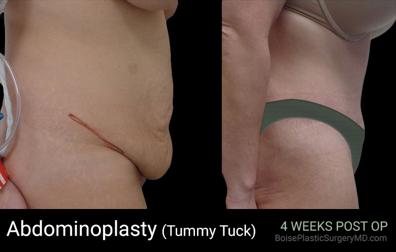Abdominoplasty (Patient C Side) - Boise Plastic Surgery