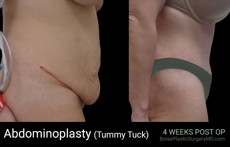 Abdominoplasty-Patient C (Side)