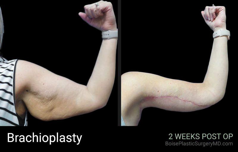 Brachioplasty - Patient A - Boise Plastic Surgery