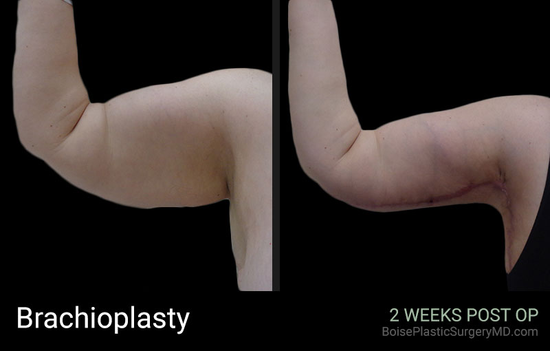 Brachioplasty – Patient C