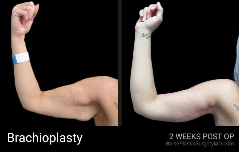 Brachioplasty (Patient B) - Boise Plastic Surgery