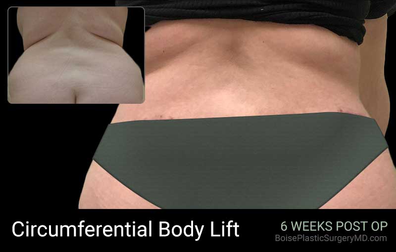 Circumferential Body Lift (Patient A Side) - Boise Plastic Surgery