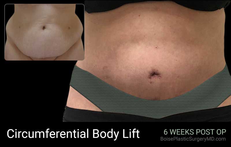 Circumferential Body Lift (Patient A Front) - Boise Plastic Surgery