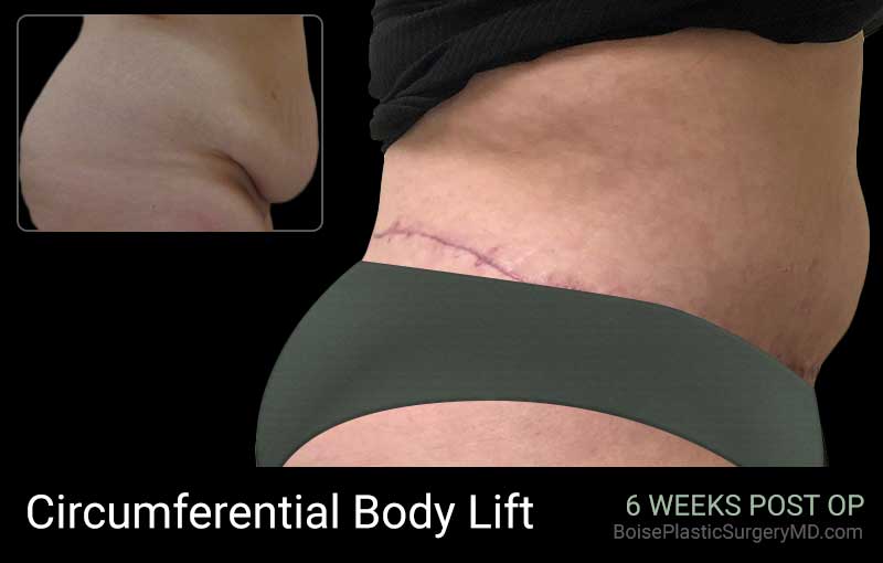 Circumferential Body Lift – Patient A – Side