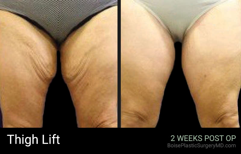 Thigh Lift(Patient A)- Boise Plastic Surgery