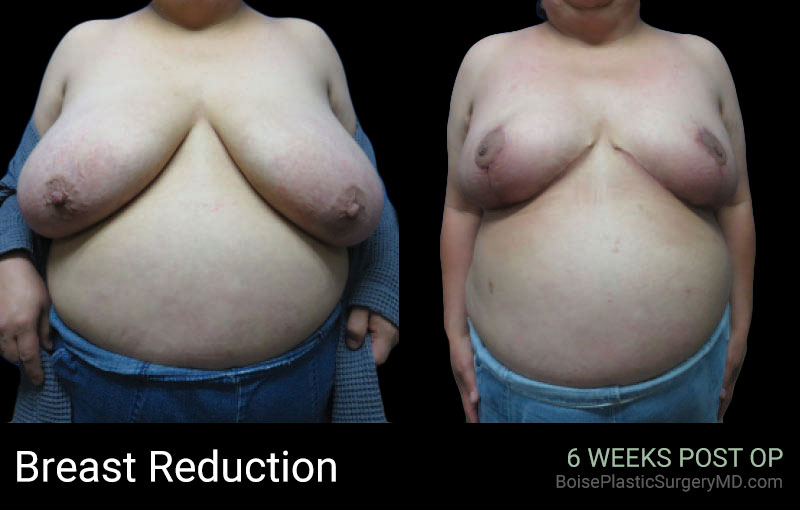 Breast Reduction- Boise Plastic Surgery