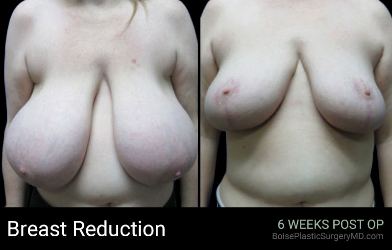 Breast Reduction – B