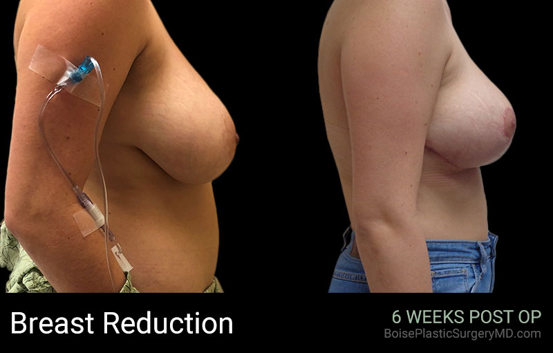 Breast Reduction (side) - Boise Plastic Surgery