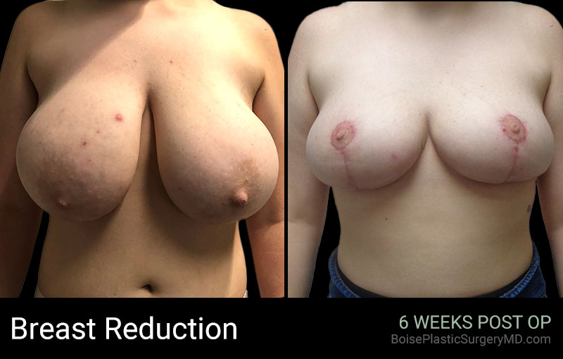 Breast Reduction (front) - Boise Plastic Surgery