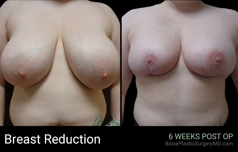 Breast Reduction (front) - Boise Plastic Surgery