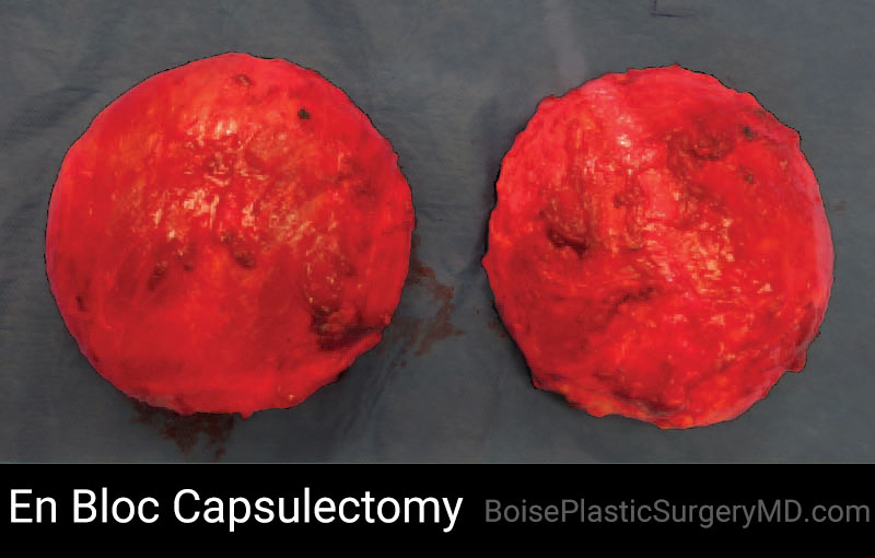 En Bloc Capsulectomy – A