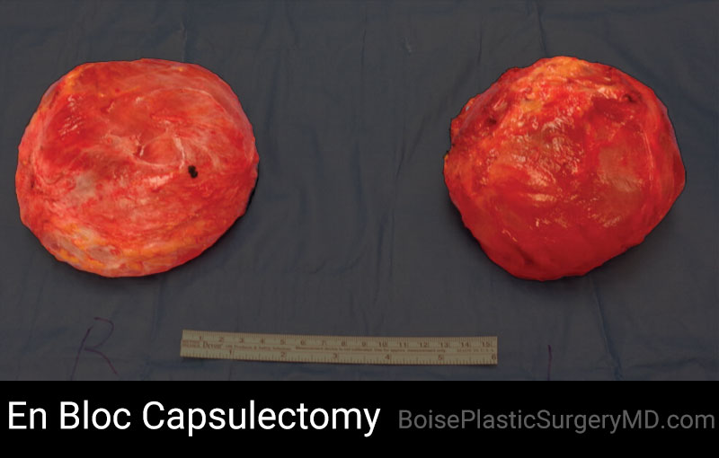 En Bloc Capsulectomy – B