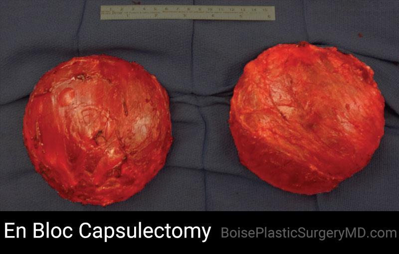 En Bloc Capsulectomy – C