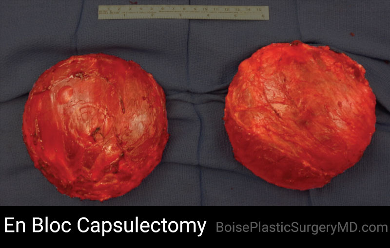 EnBloc Capsulectomy - Boise Plastic Surgery