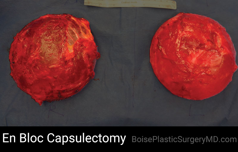 En Bloc Capsulectomy – D
