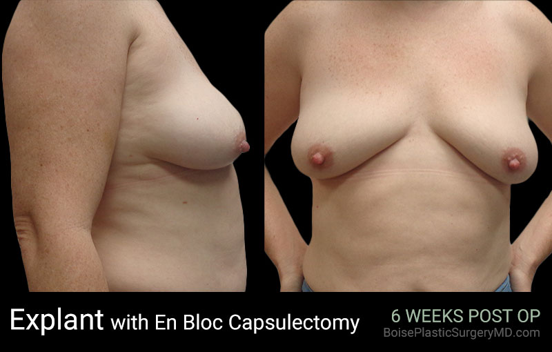 Explant with EnBloc Capsulectomy- Boise Plastic Surgery