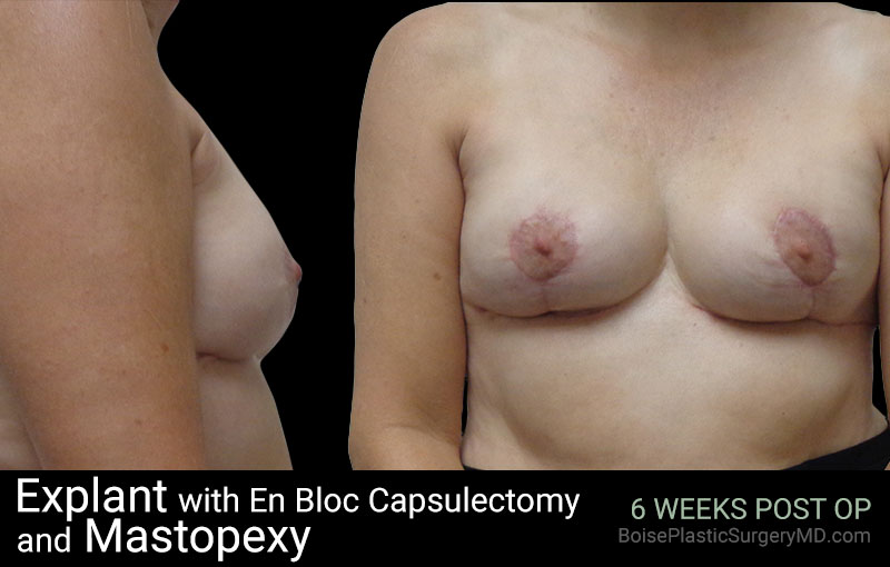 Explant with EnBloc Capsulectomy And Mastopexy - Boise Plastic Surgery