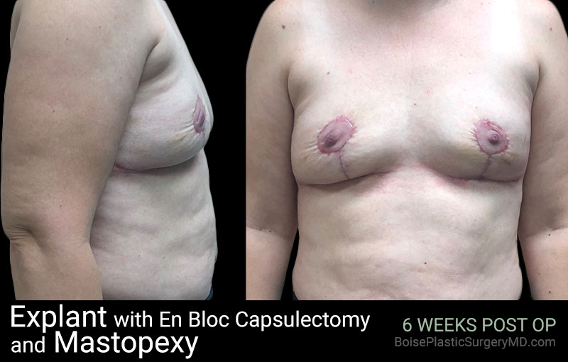 Explant with En Bloc Capsulectomy & Mastopexy – B