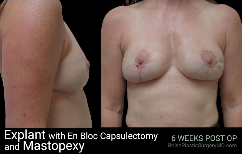 Explant with EnBloc Capsulectomy And Mastopexy - Boise Plastic Surgery