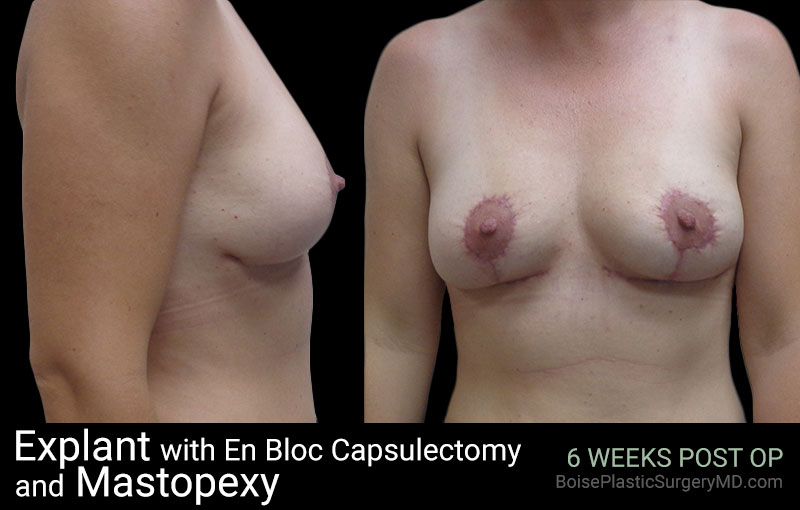 Explant with En Bloc Capsulectomy & Mastopexy – D