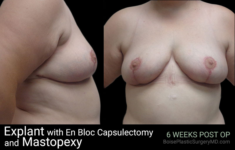 Explant with EnBloc Capsulectomy And Mastopexy - Boise Plastic Surgery
