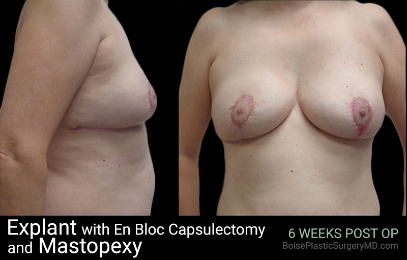 Explant with EnBloc Capsulectomy And Mastopexy - Boise Plastic Surgery