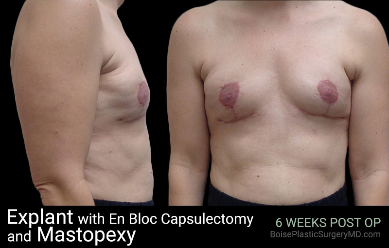 Explant with EnBloc Capsulectomy And Mastopexy - Boise Plastic Surgery