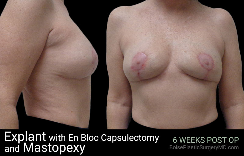 Explant with En Bloc Capsulectomy & Mastopexy – I