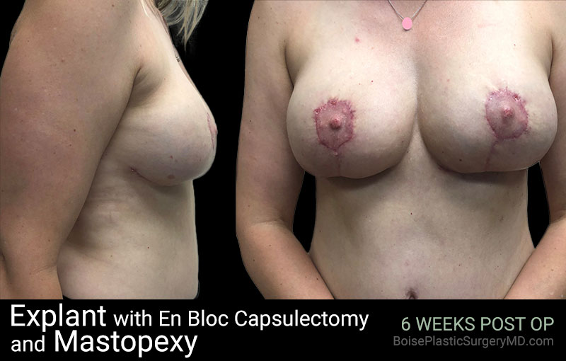 Explant with EnBloc Capsulectomy And Mastopexy - Boise Plastic Surgery