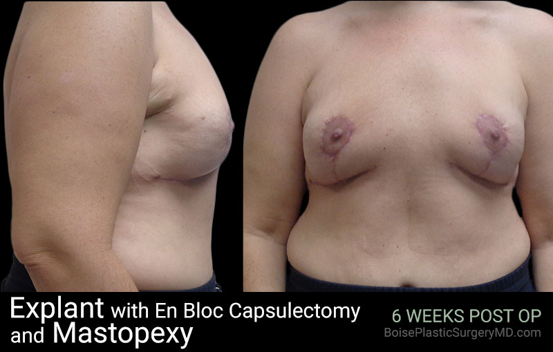 Explant with EnBloc Capsulectomy And Mastopexy - Boise Plastic Surgery