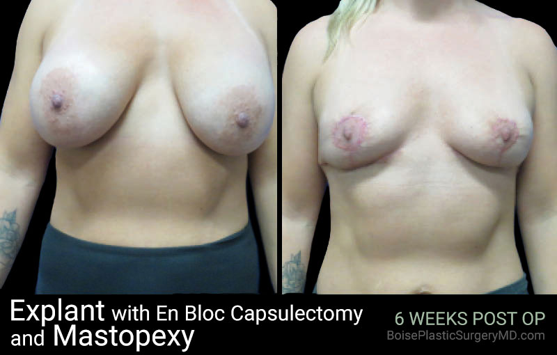 Explant with EnBloc Capsulectomy And Mastopexy - Boise Plastic Surgery