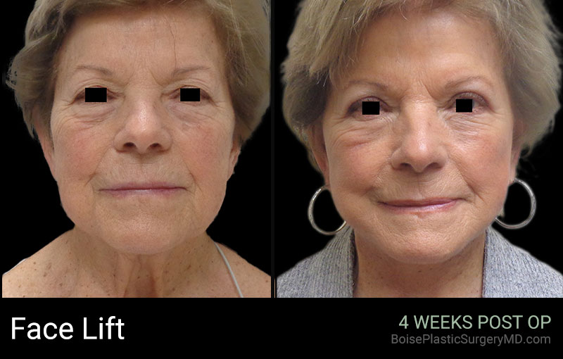 Face Lift (Patient B) - Boise Plastic Surgery