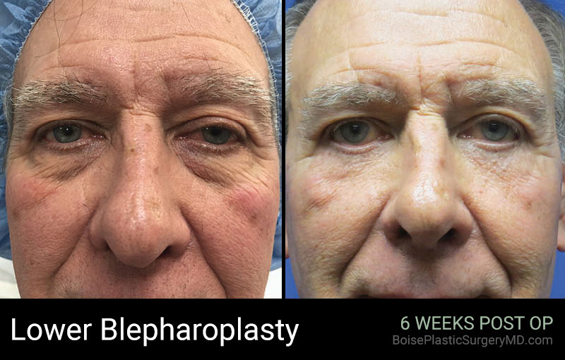 Lower Blepharoplasty – Patient A