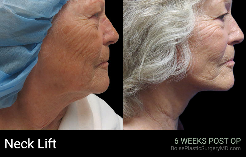 Neck Lift – Patient A