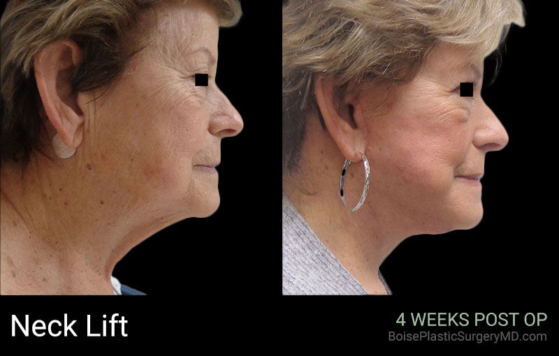 Neck Lift – Patient B