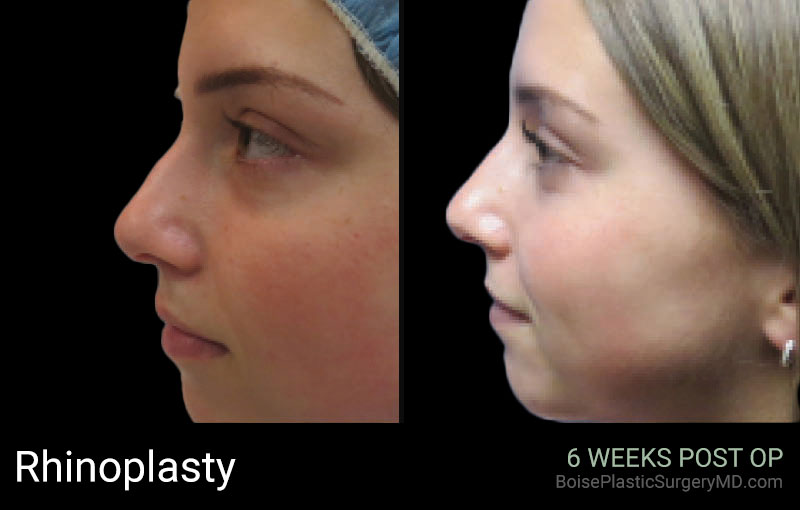Rhinoplasty – Patient A