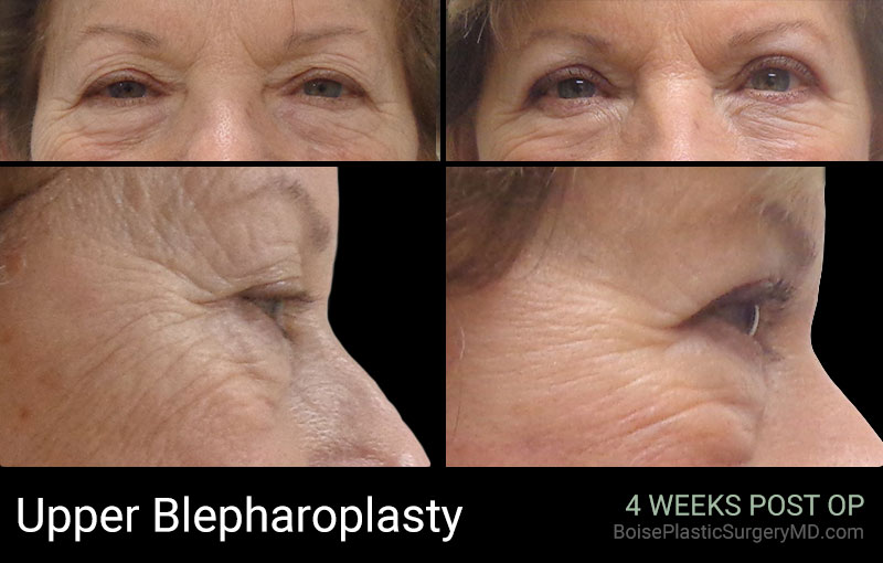 Upper Blepharoplasty – Patient A