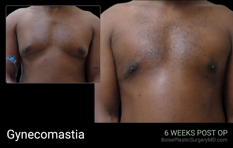 Gynecomastia – A (front)