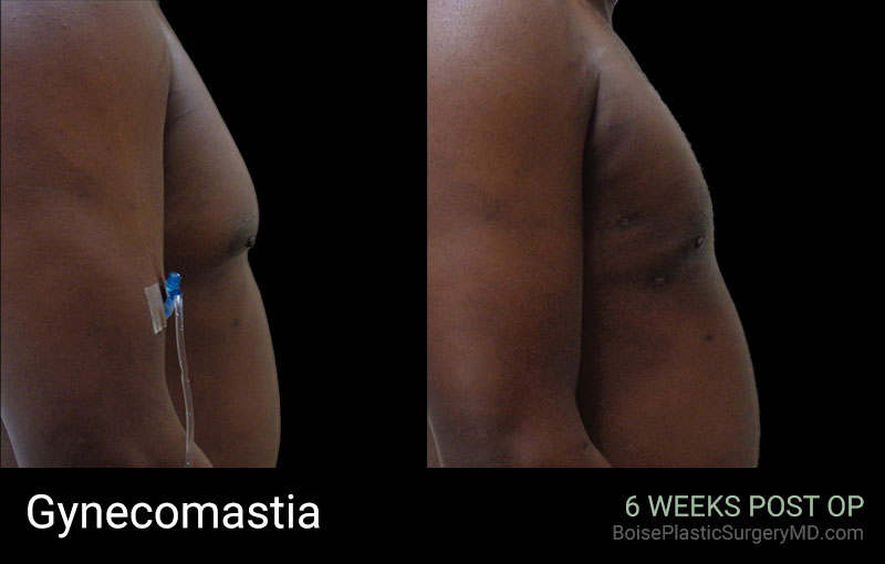 Gynecomastia – A