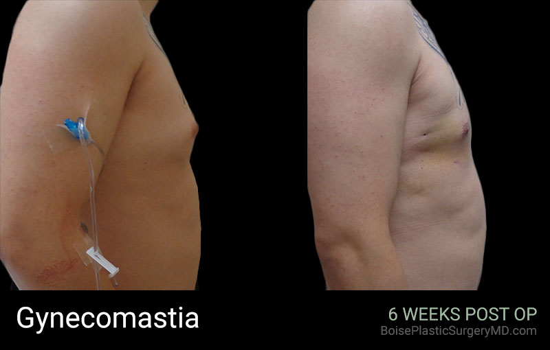 Gynecomastia – C