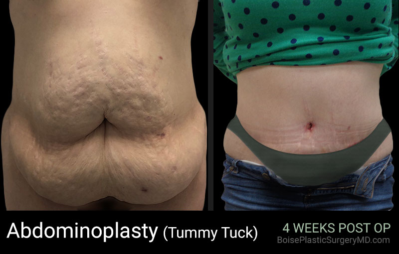 Abdominoplasty (Patient D Front) - Boise Plastic Surgery