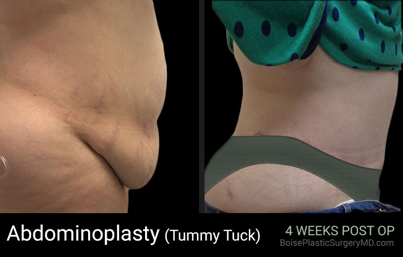 Abdominoplasty (Patient D Side) - Boise Plastic Surgery