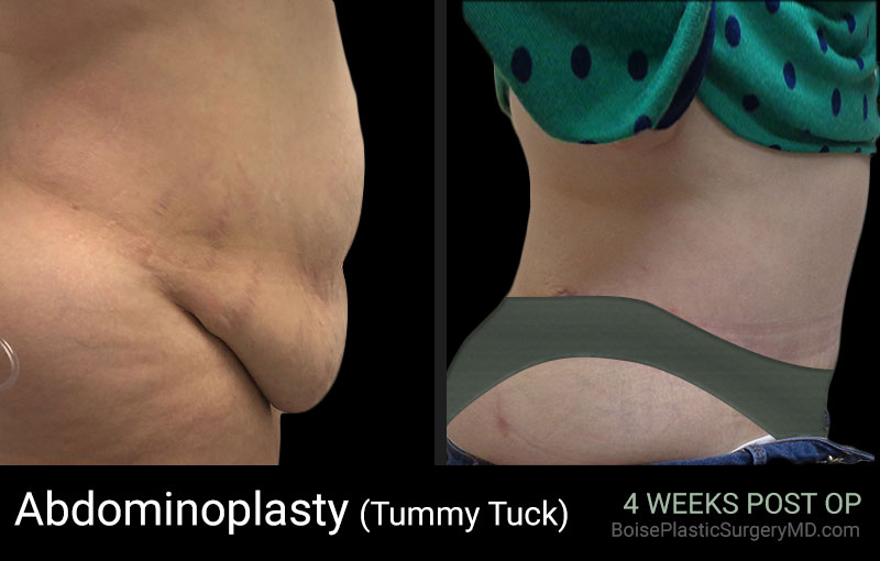 Abdominoplasty-Patient D (Side)