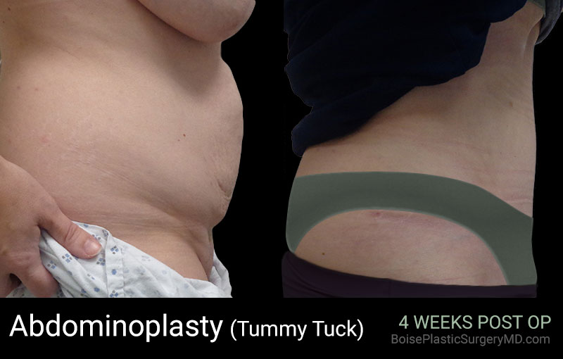 Abdominoplasty-PatientE-Side