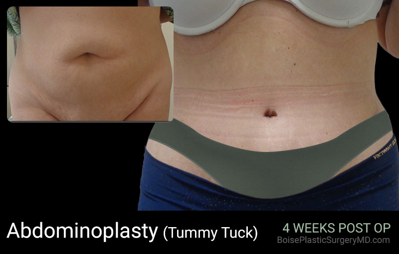 Abdominoplasty Patient F Front